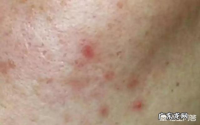 全脸都是痘印和痘坑，应该怎么护理？