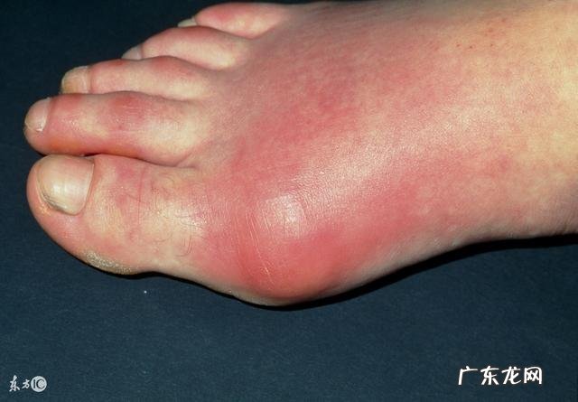 牛奶营养价值高,痛风病人可以喝吗?