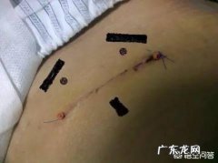 现在剖腹产还会留疤吗？