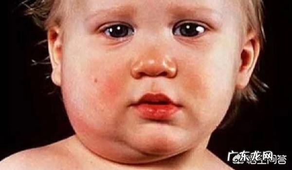 流行性腮腺炎的症状及如何预防?