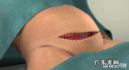 第一胎剖腹产,二胎想顺产需要注意什么?还是必须得剖腹产呢?