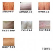 最近宝宝得了荨麻疹，有哪些好的治疗方法？