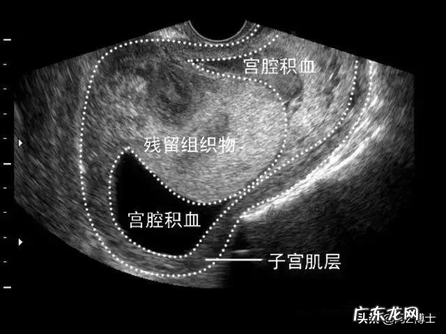 准妈妈该如何预防晚期产后出血?
