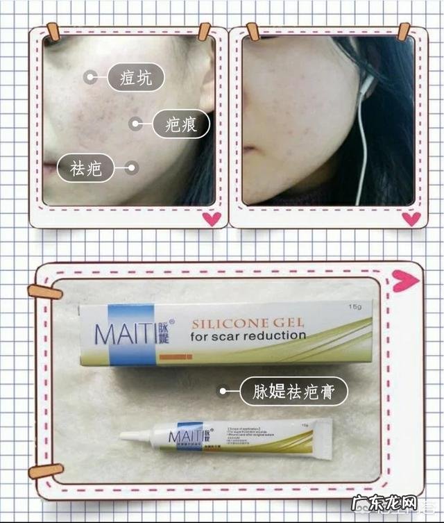 求助大家,陈年痘印,有祛痘印的方法吗?