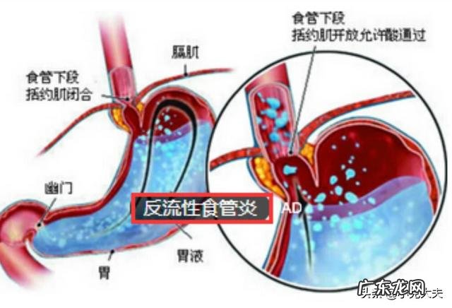老有反酸烧心是怎么回事?