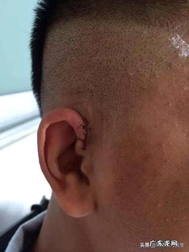 患有先天性耳前瘘管该怎么办?