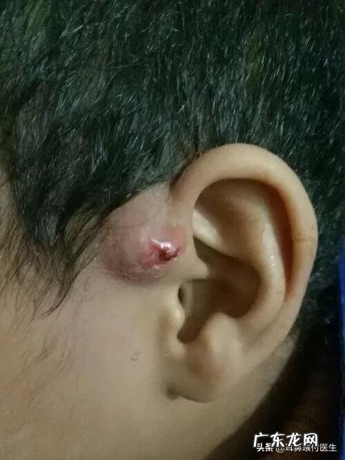 患有先天性耳前瘘管该怎么办?