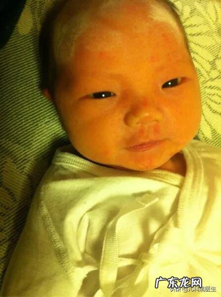 新生儿10个有9个黄疸,如何快速去黄疸?