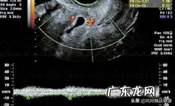 疤痕妊娠会导致胎停吗?怎么通过B超看是不是疤痕妊娠?