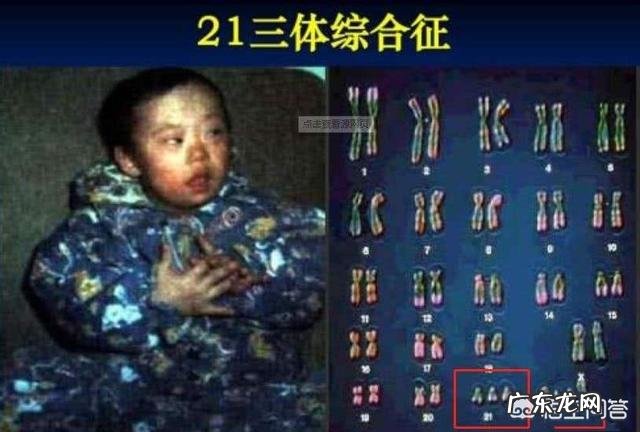 羊水穿刺结果异常必须做引产吗?