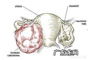 卵巢癌晚期如何减轻痛苦?