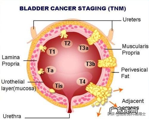 膀胱癌发展到什么程度算是晚期？