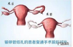 恢复结扎复通后一个月可以备孕吗？