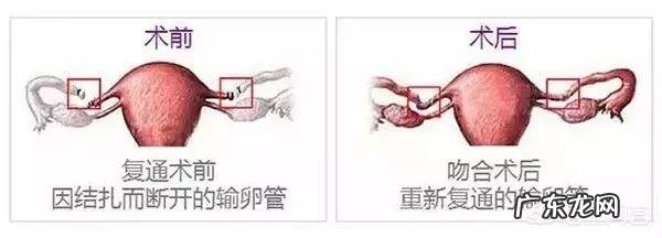 恢复结扎复通后一个月可以备孕吗?