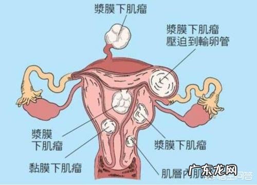 子宫肌瘤为何会导致不孕?