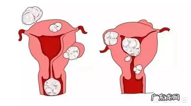 子宫肌瘤为何会导致不孕?