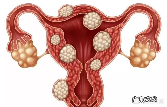 子宫肌瘤为何会导致不孕?
