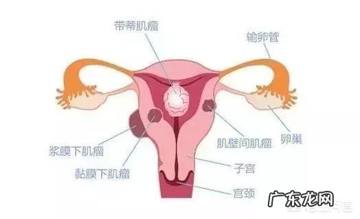 子宫肌瘤为何会导致不孕?
