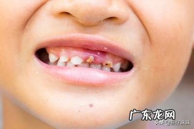 如何预防宝宝蛀牙？