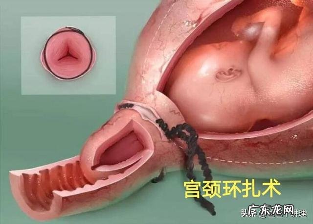 假性宫缩和早产征兆有什么区别，如何防治早产？