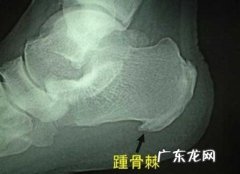 脚后跟骨刺是怎么形成的？