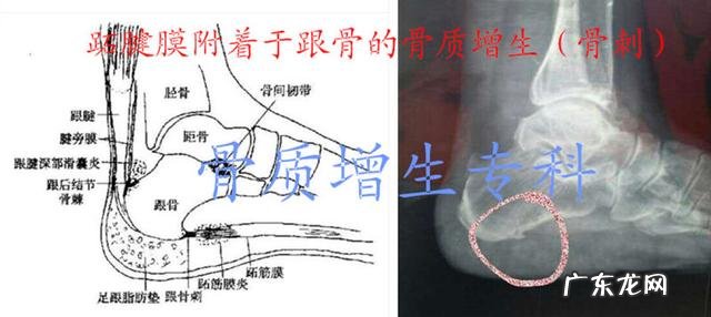 脚后跟骨刺是怎么形成的?