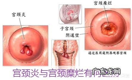 宫颈炎与宫颈糜烂是一回事吗?