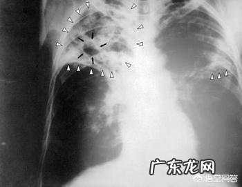 肺结核会传染吗？