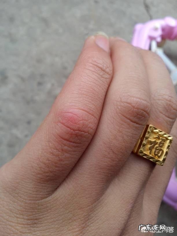 医学上如何解释长冻疮?