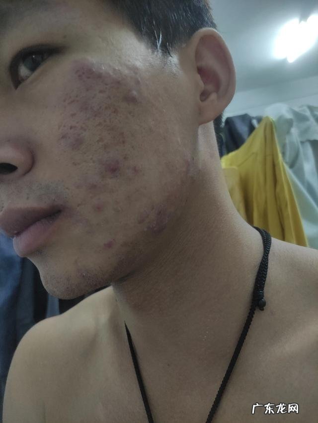 男生脸上长痤疮怎么办？