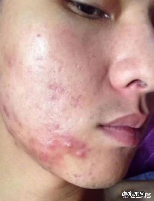 男生脸上长痤疮怎么办？