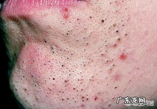 男生脸上长痤疮怎么办?