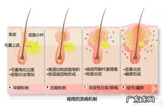 男生脸上长痤疮怎么办？