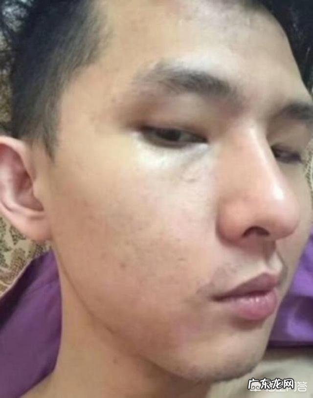 男生脸上长痤疮怎么办？