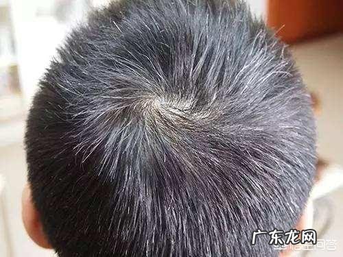 怎么治疗少年白,大家有什么办法?