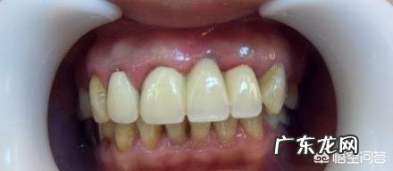 四环素牙如何美白?