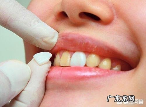 四环素牙如何美白?