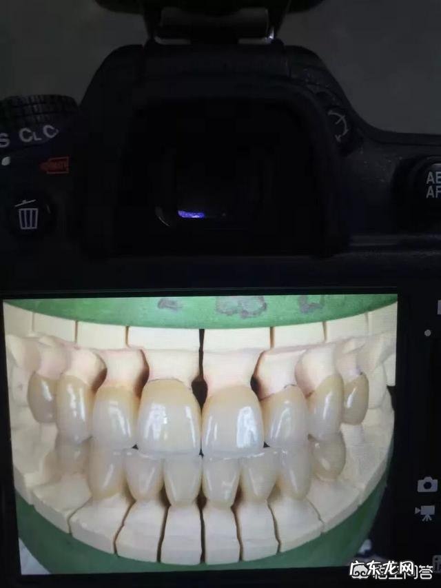 四环素牙如何美白?