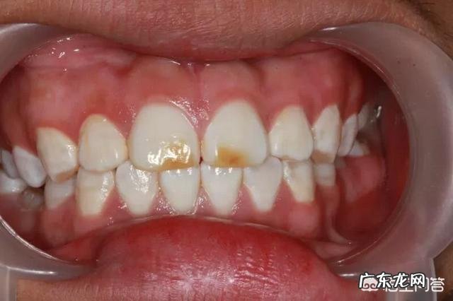 四环素牙如何美白?