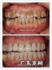 四环素牙如何美白?