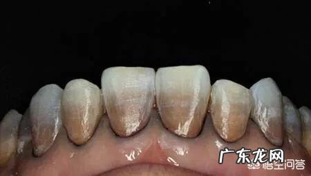 四环素牙如何美白?