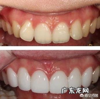 四环素牙如何美白?