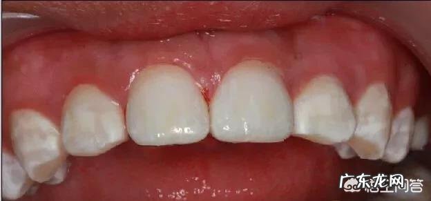 四环素牙如何美白?