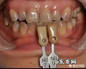 四环素牙如何美白?