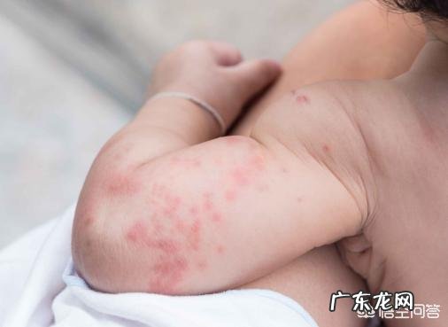 宝宝皮肤过敏要注意什么?