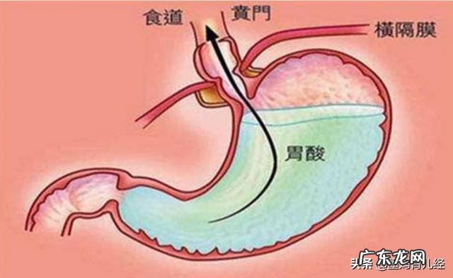 孕妇胃反酸像火烧喉咙怎么办？
