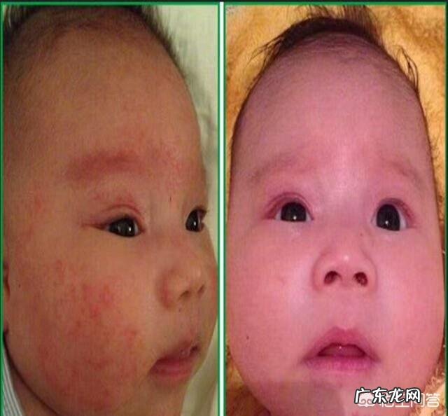 宝宝长奶癣是因为喝奶引起的吗?应该怎么办?