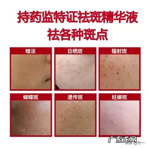 怎么祛痘或者祛斑?