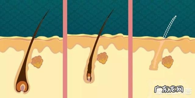 为什么只有男性会严重脱发?