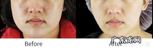 打瘦脸针的危害有哪些?